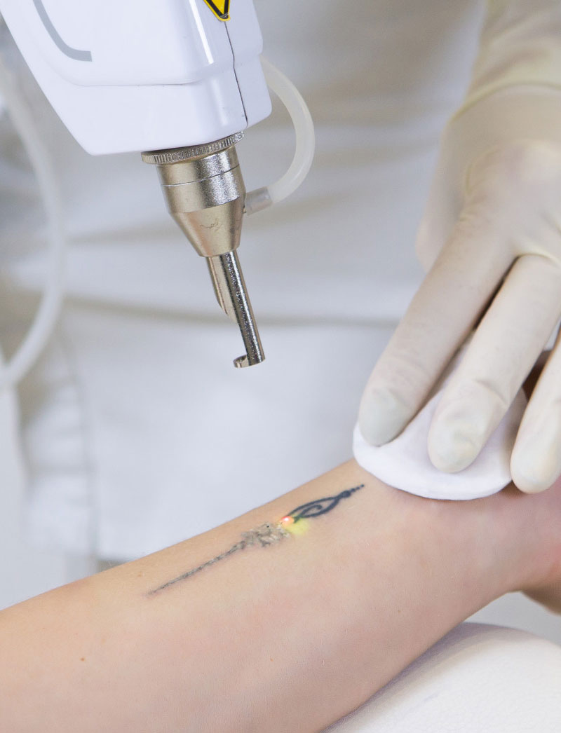 Laser Tattoo Removal and Micro-Needling Hendersonville, TN