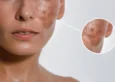 Woman with Melasma