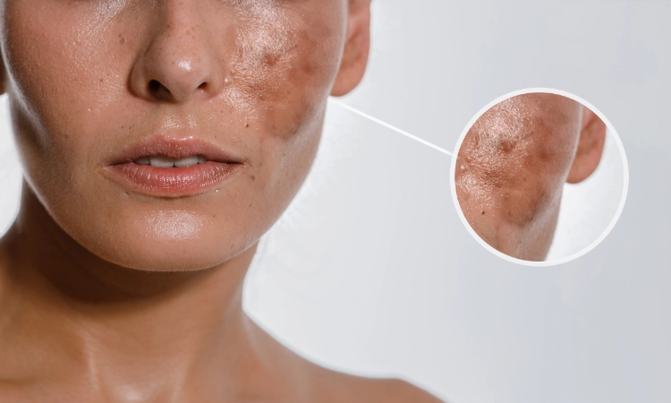 Woman with Melasma