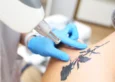 tattoo removal to a patient in Skinworks Wellness