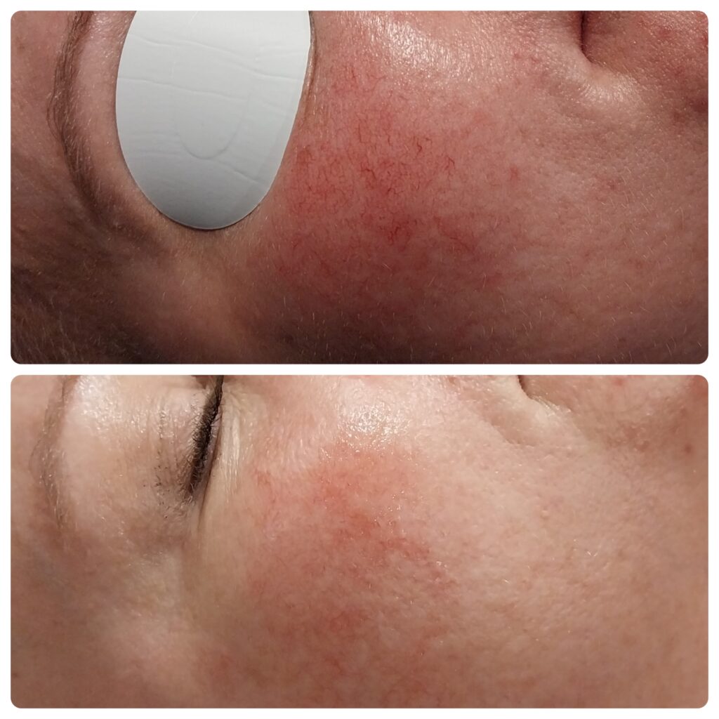 before and after of a laser treatment of spider veins in cheeks