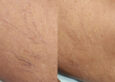 skin showing spider veins