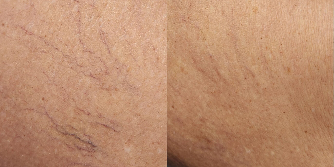 skin showing spider veins