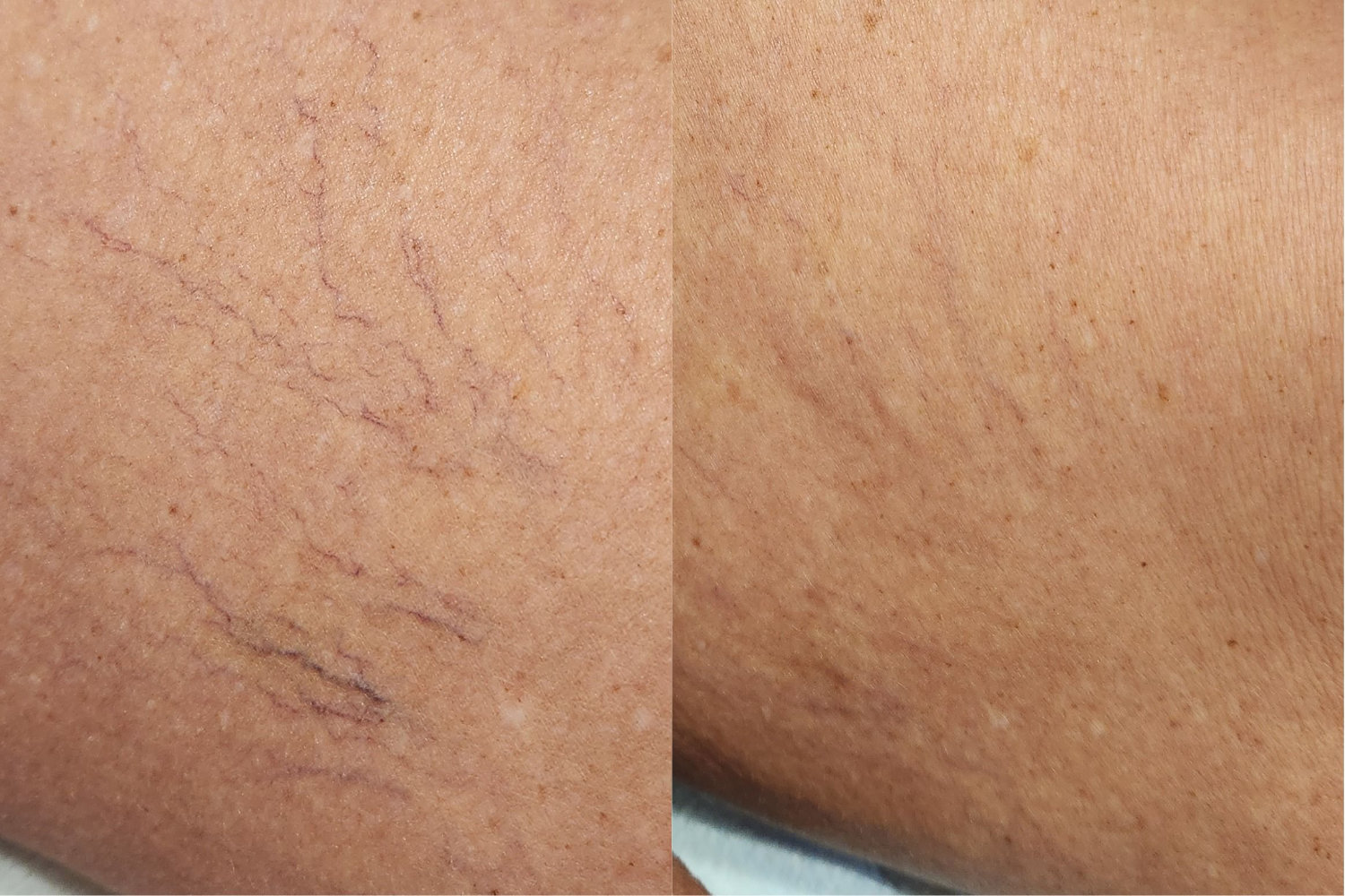 skin showing spider veins